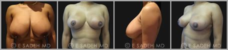 Breast Reduction - Patient 10