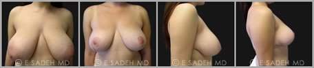 Breast Reduction - Patient 11