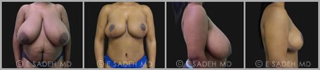 Breast Reduction - Patient 12