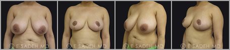 Breast Reduction - Patient 13