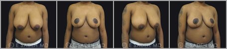 Breast Reduction - Patient 14