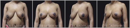 Breast Reduction - Patient 15