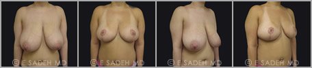 Breast Reduction - Patient 16