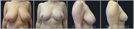 Breast Reduction - Patient 2