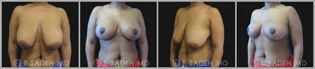 Breast Reduction - Patient 4