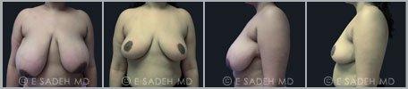 Breast Reduction - Patient 5