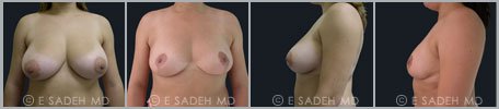 Breast Reduction - Patient 6