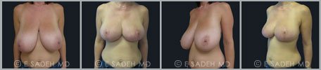 Breast Reduction - Patient 7