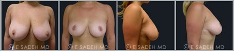 Breast Reduction - Patient 8