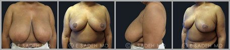 Breast Reduction - Patient 9