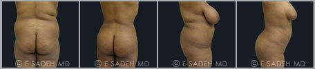 Liposuction - Patient 1