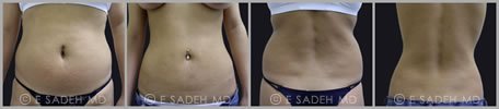 Liposuction - Patient 10