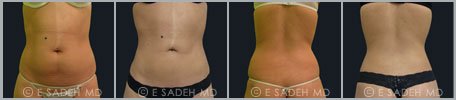 Liposuction - Patient 2