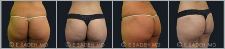 Liposuction - Patient 3