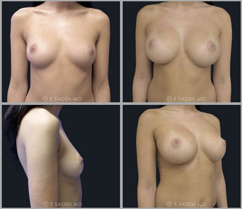 breast augmentation with implants